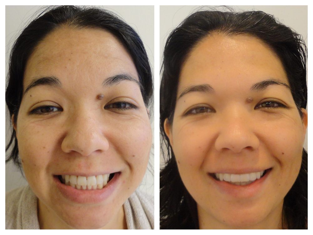 Real Invisalign Patient